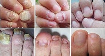 兰州北大皮肤病专科